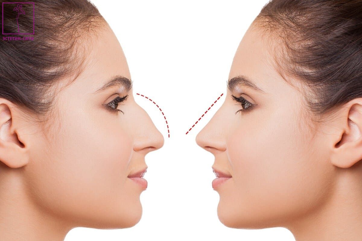 Какие операции делают на носу
